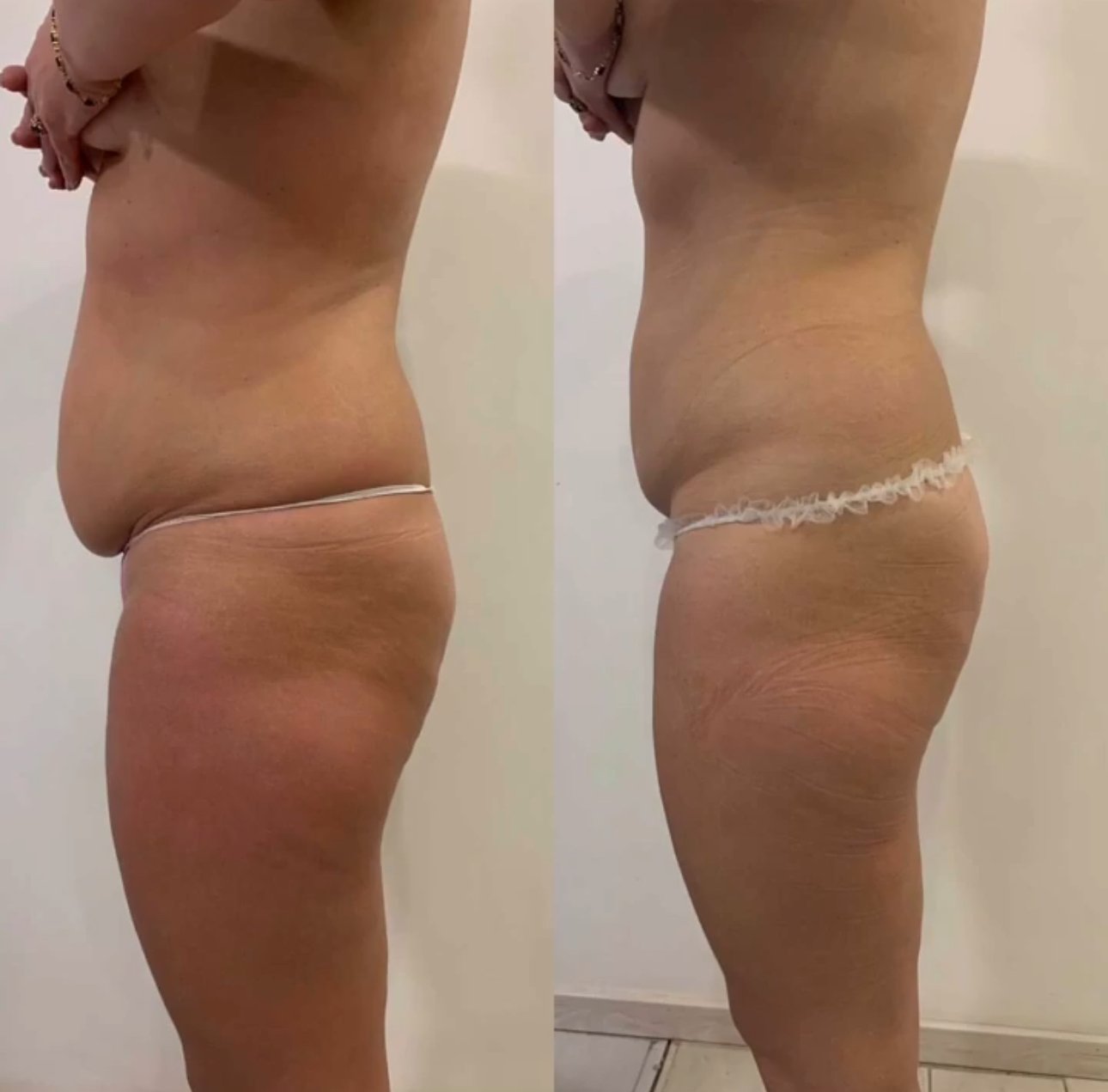 STYX Cello Gel before and after result